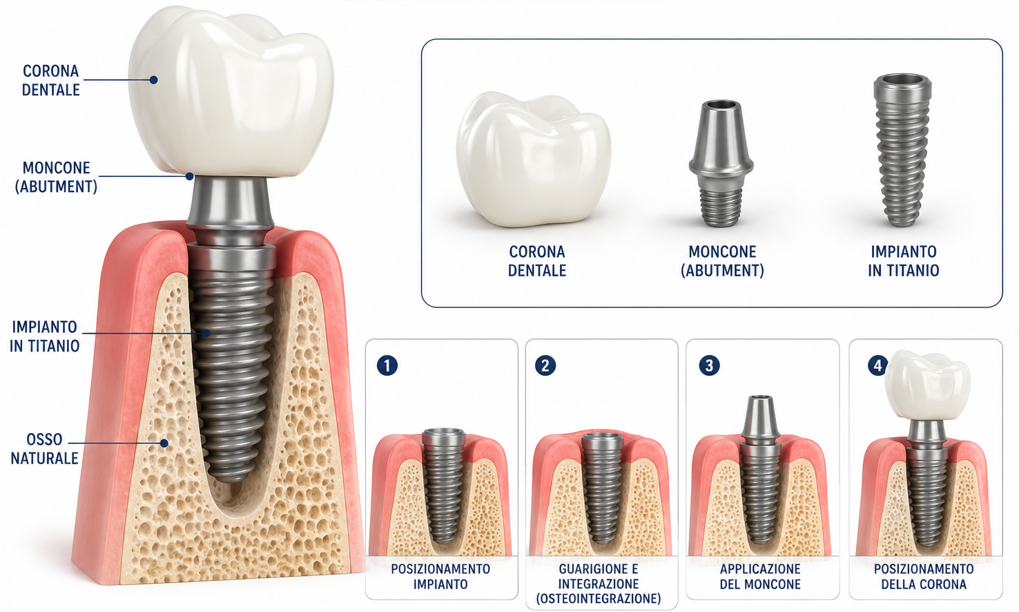 Sezione di un impianto dentale singolo: corona, moncone (abutment) e vite in titanio inseriti nell'osso naturale