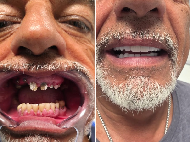 Foto prima/dopo del trattamento di Mario Serra, condivisa nella sua recensione